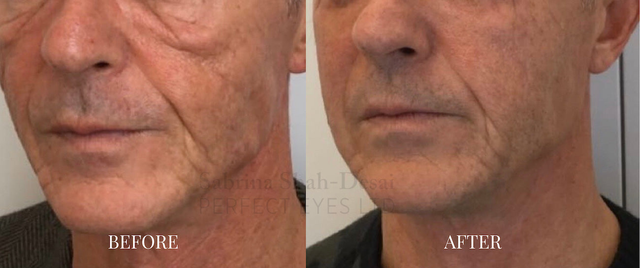 Morpheus8 RF Microneedling