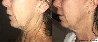 Morpheus8 RF Microneedling