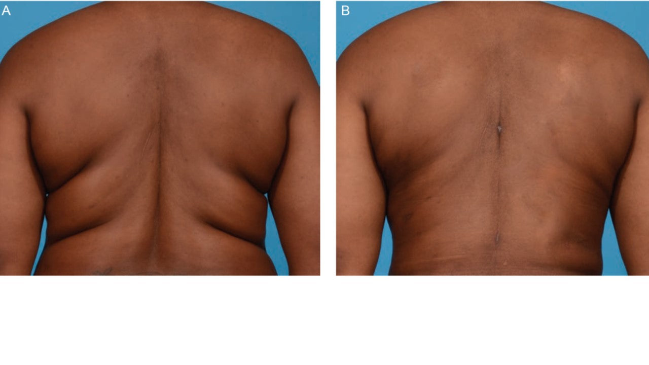 Morpheus8 RF Microneedling