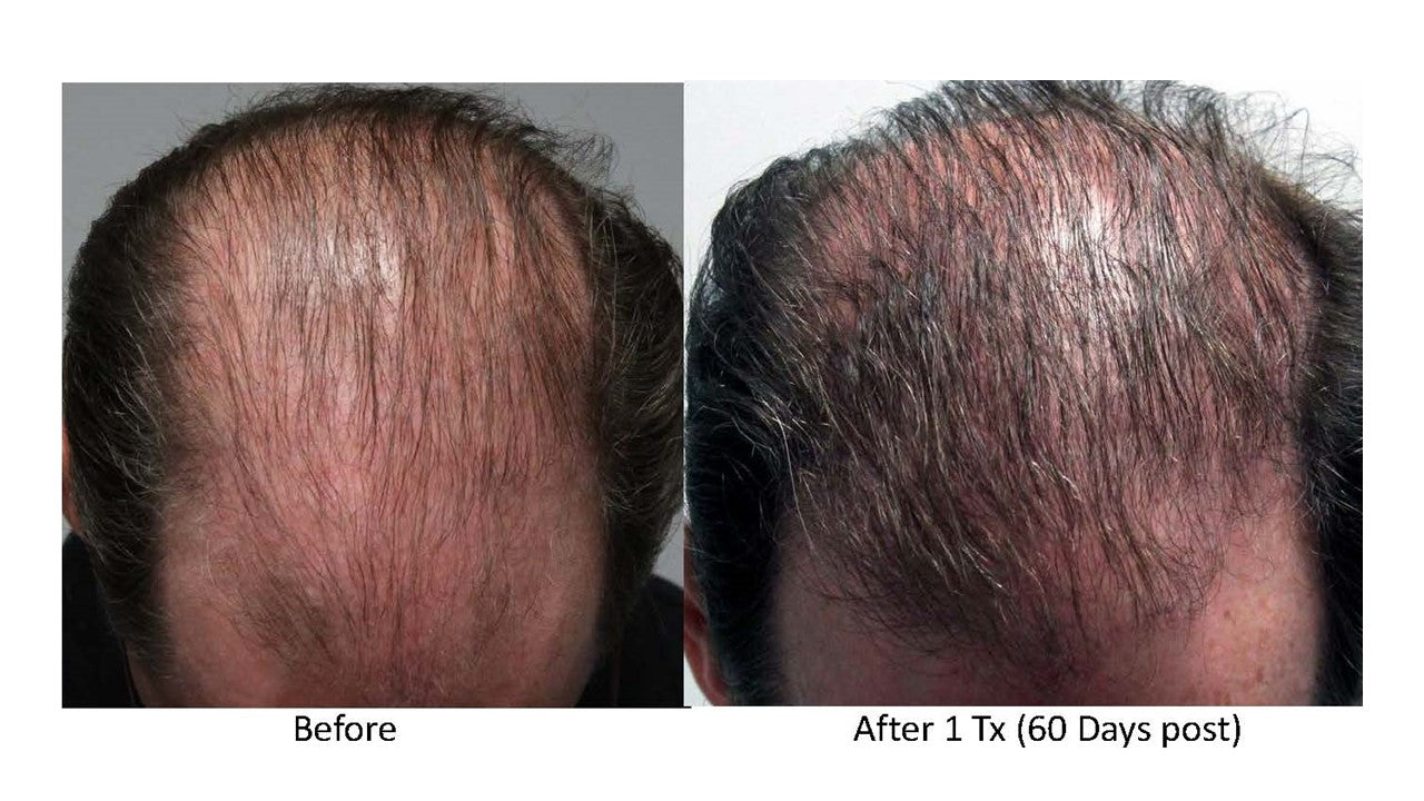 PRP Hair Restoration Package
